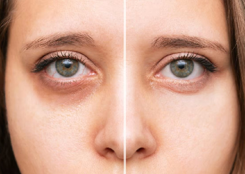 Dark Circle Treatment