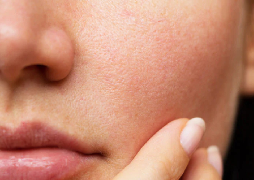 Open Pores Reduction