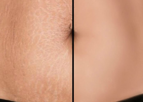 Stretch Marks Reduction