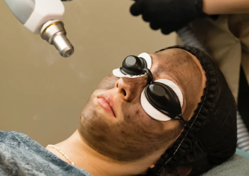 Carbon Laser Facial