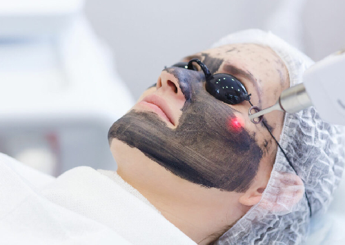 Carbon Laser Peel